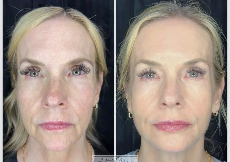Antes e depois de Cláudia M. usando Celimax